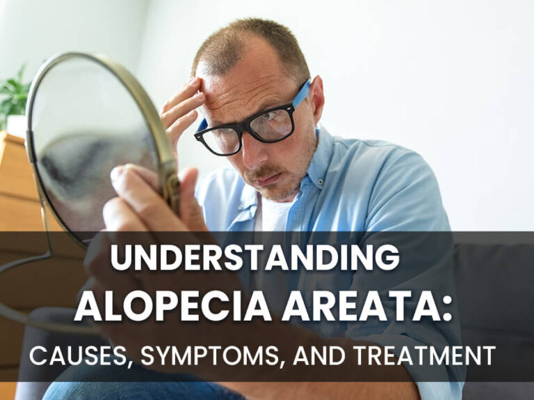 Alopecia Areata: Causes, Symptoms, and Treatment - Estenove