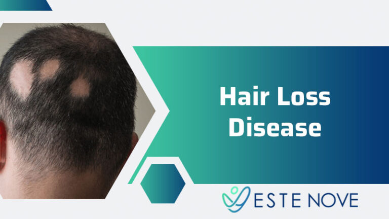 Understanding Hair Loss Disease - Estenove