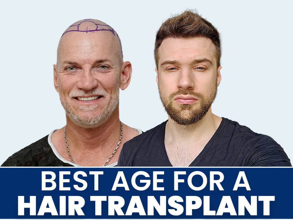 Best Age For A Hair Transplant