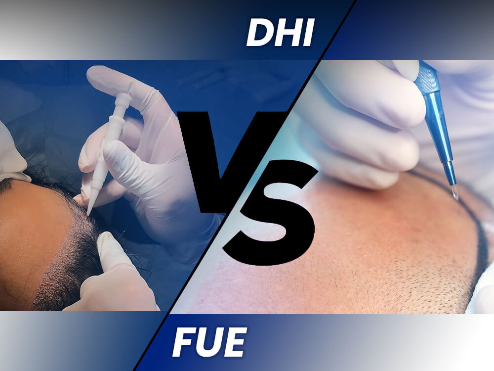 DHI vs FUE Hair Transplants: A Comprehensive Comparison