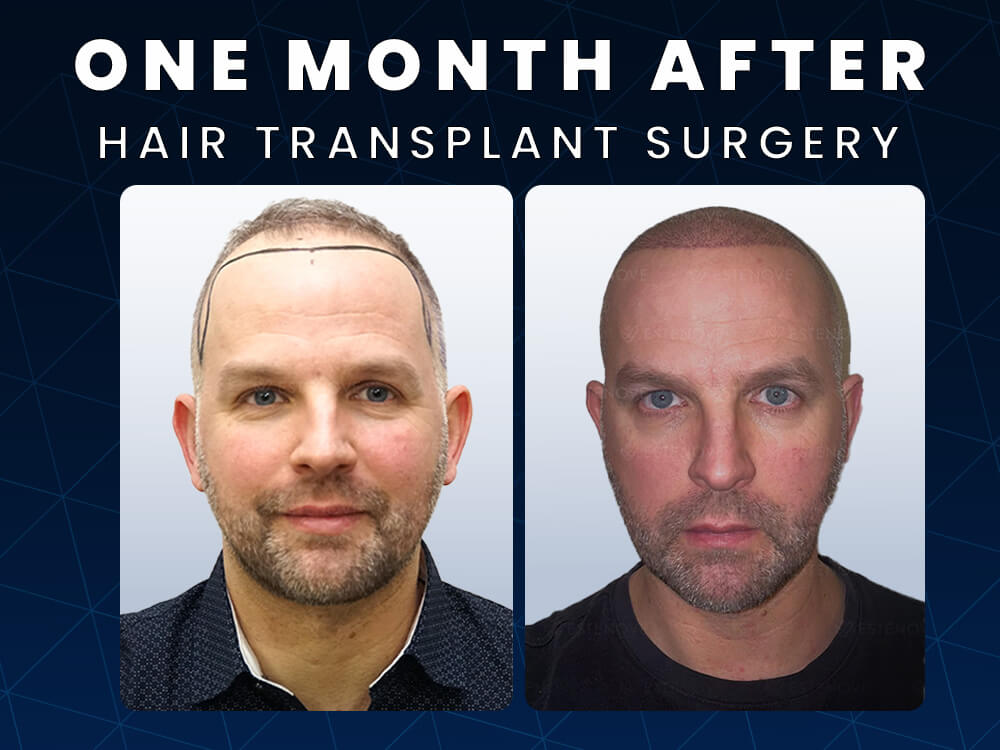 One Month After Hair Transplant Surgery Before After Photos