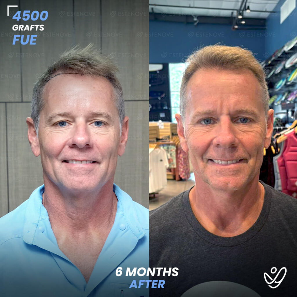 Male FUE 4500 Grafts 6 Months Before&After