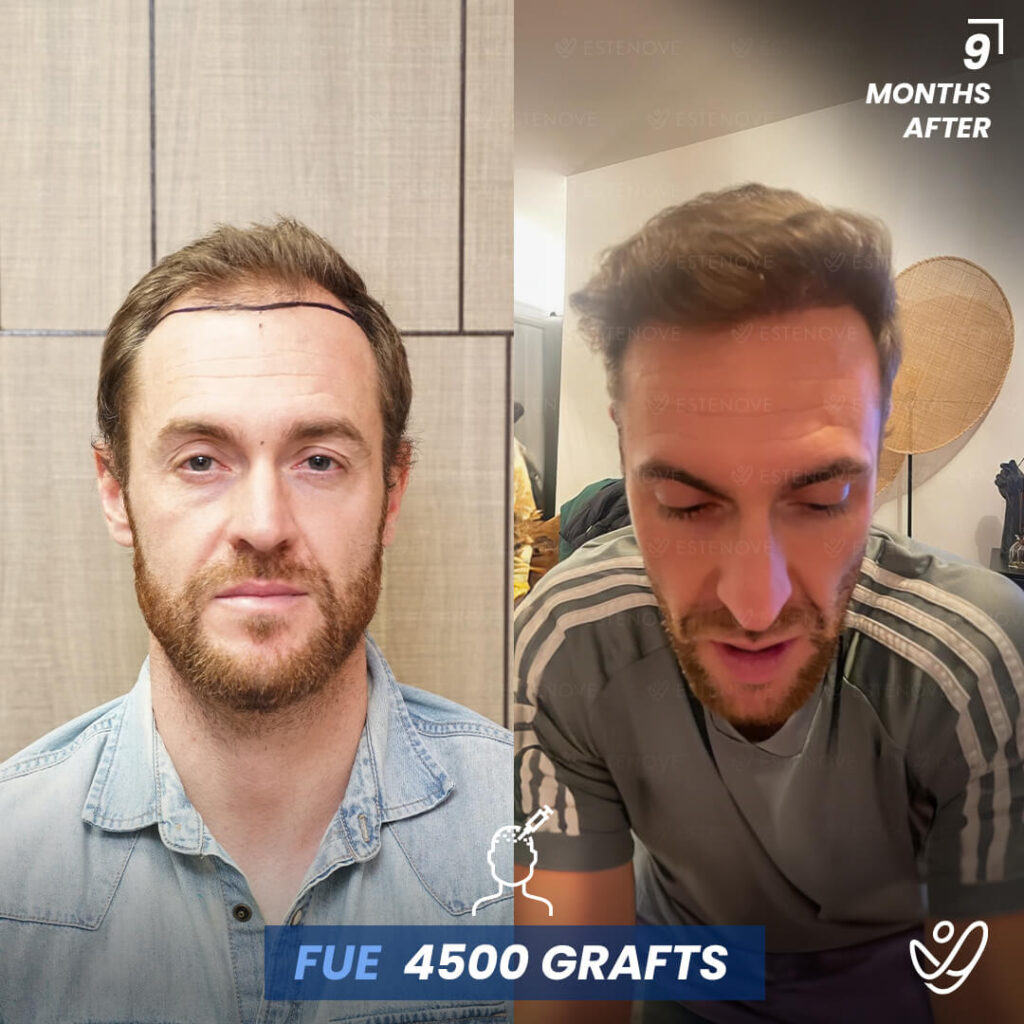 Male FUE 4500 Grafts 9 Months Before&After