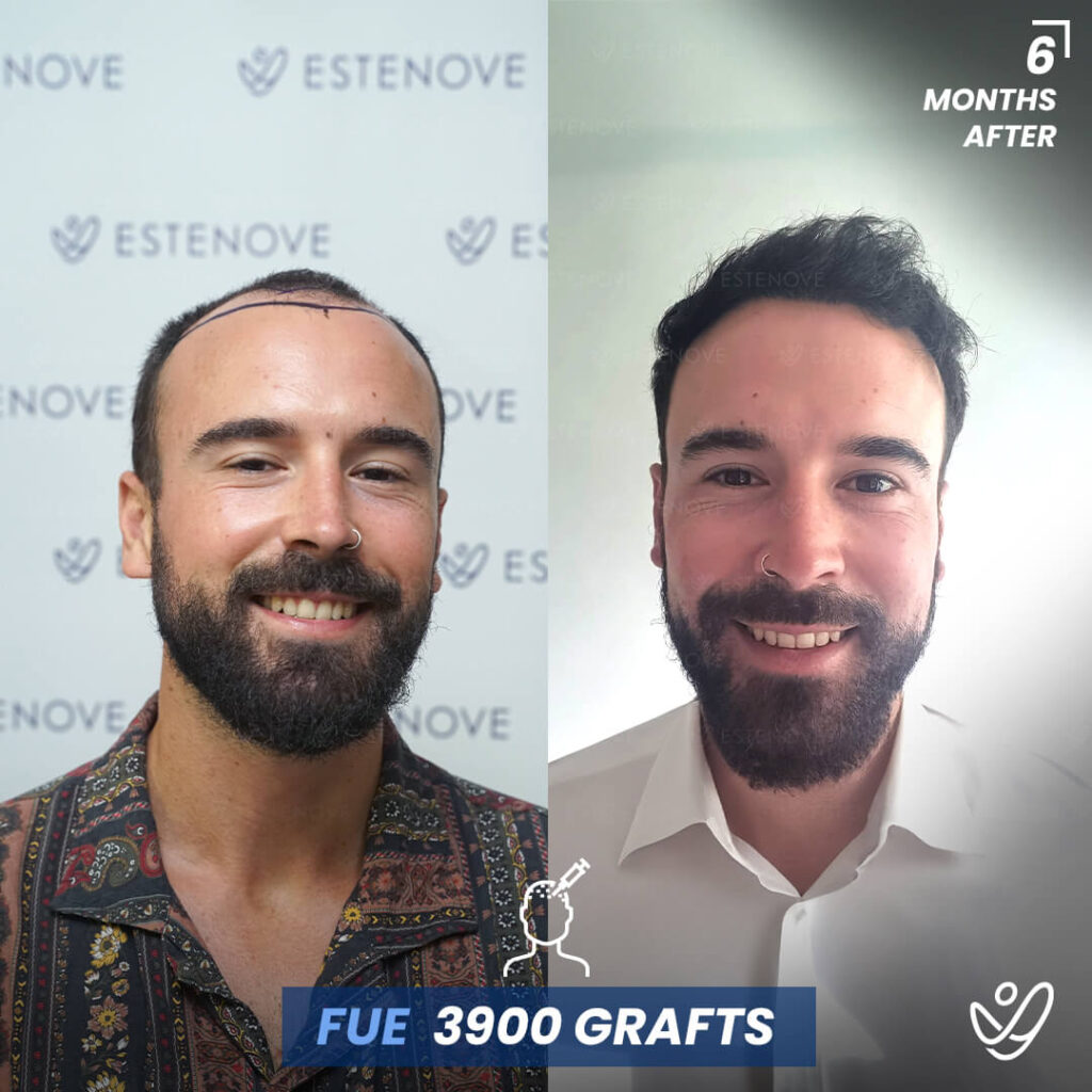 Male FUE 3900 Grafts 6 Months Before&After