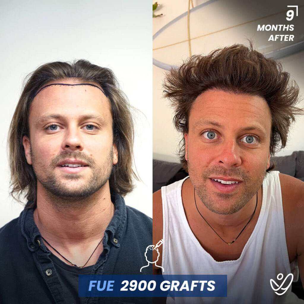 Male FUE 2900 Grafts 9 Months Before&After