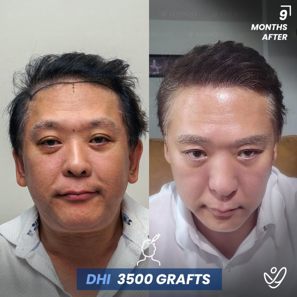 Male DHI 3500 Grafts 9 Months Before&After