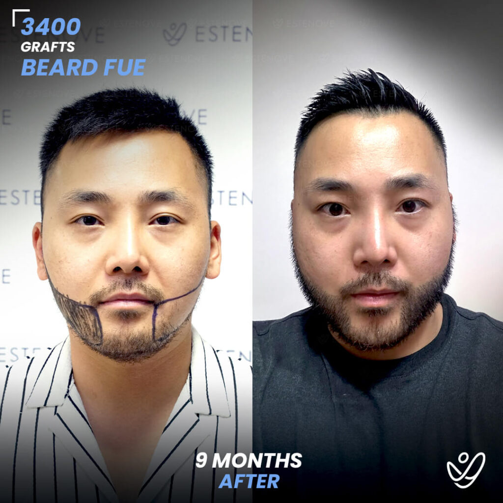 Male FUE 3400 Grafts 9 Months Before&After