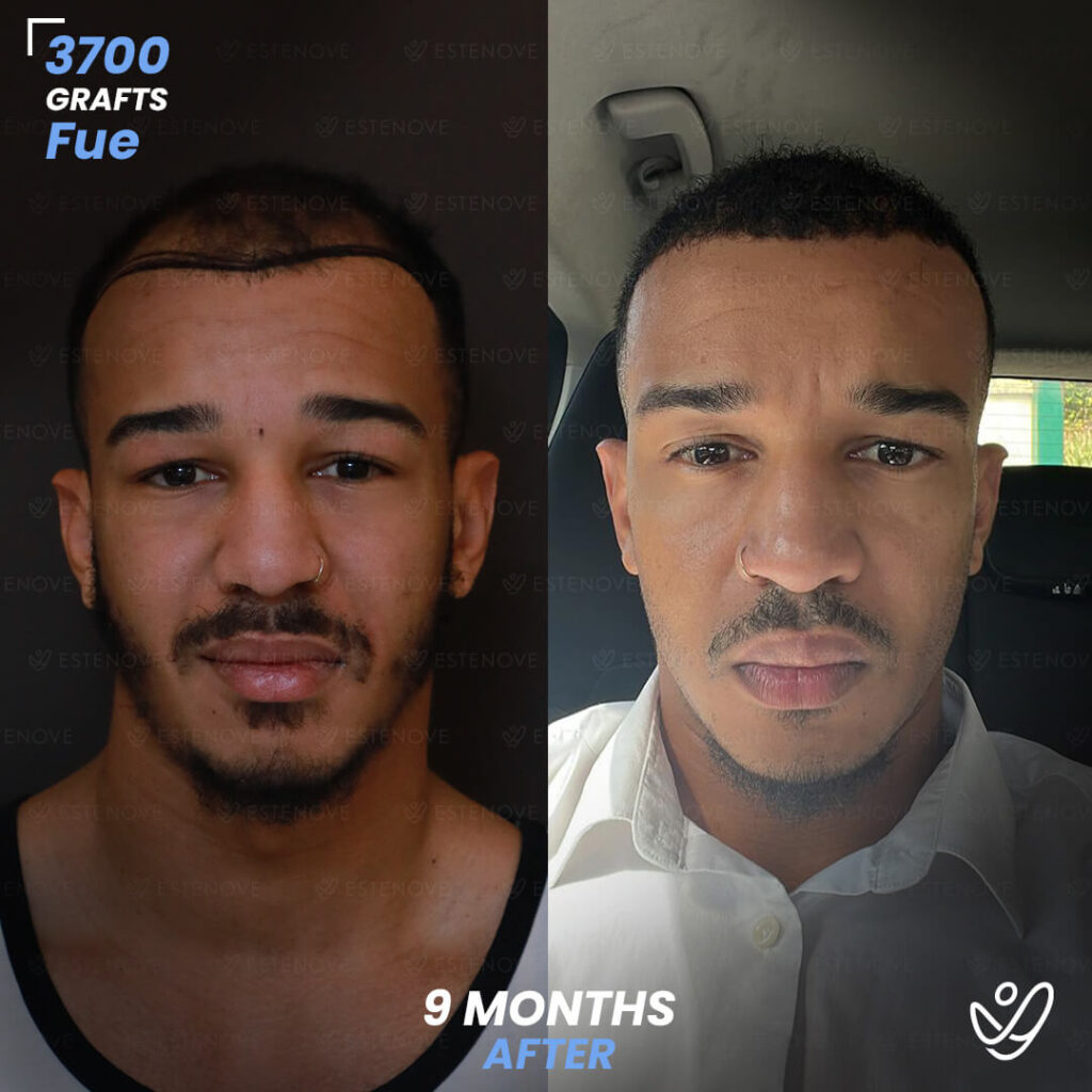 Male FUE 3700 Grafts 9 Months Before&After