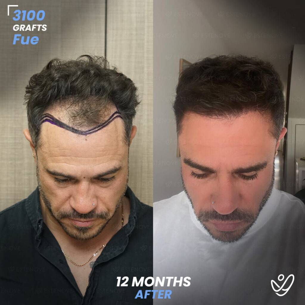 Male FUE 3100 Grafts 12 Months Before&After