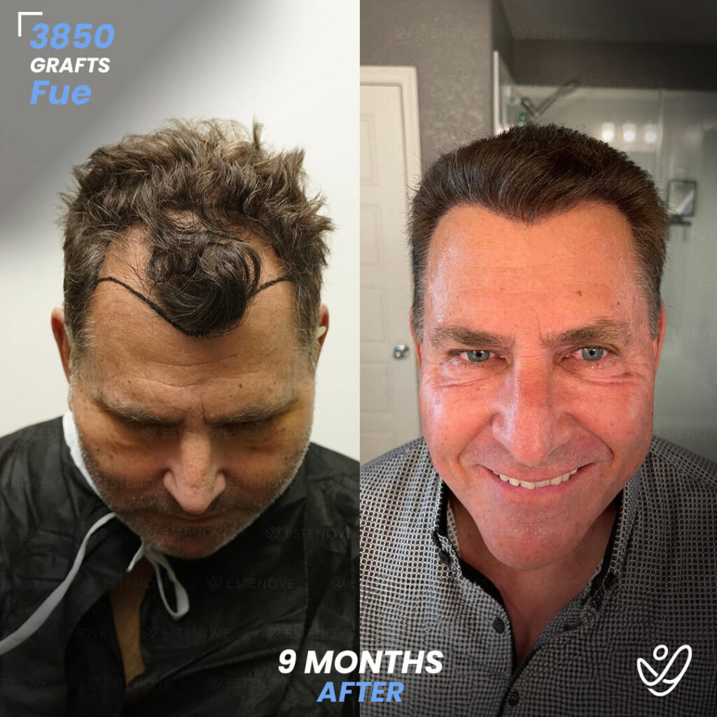 Male FUE 3850 Grafts 9 Months Before&After