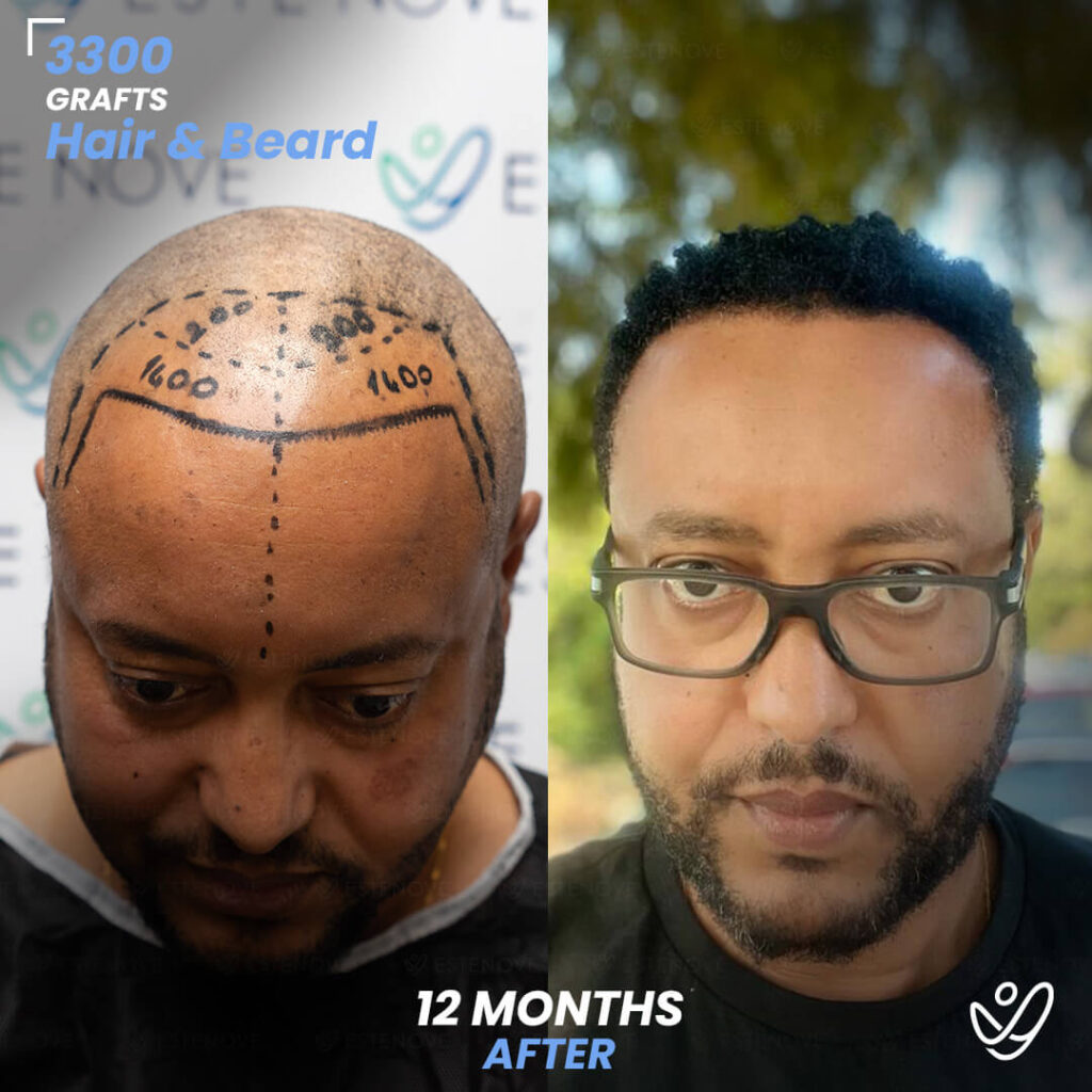 Male Hair&Beard Transplant - 3300 grafts 12 Months Before&After