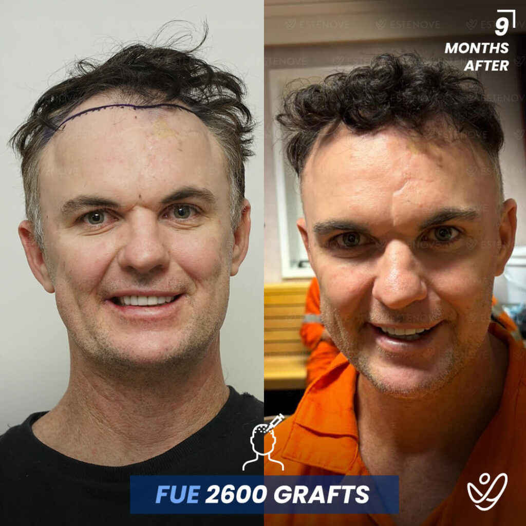 Male FUE 2600 Grafts 9 Months Before&After