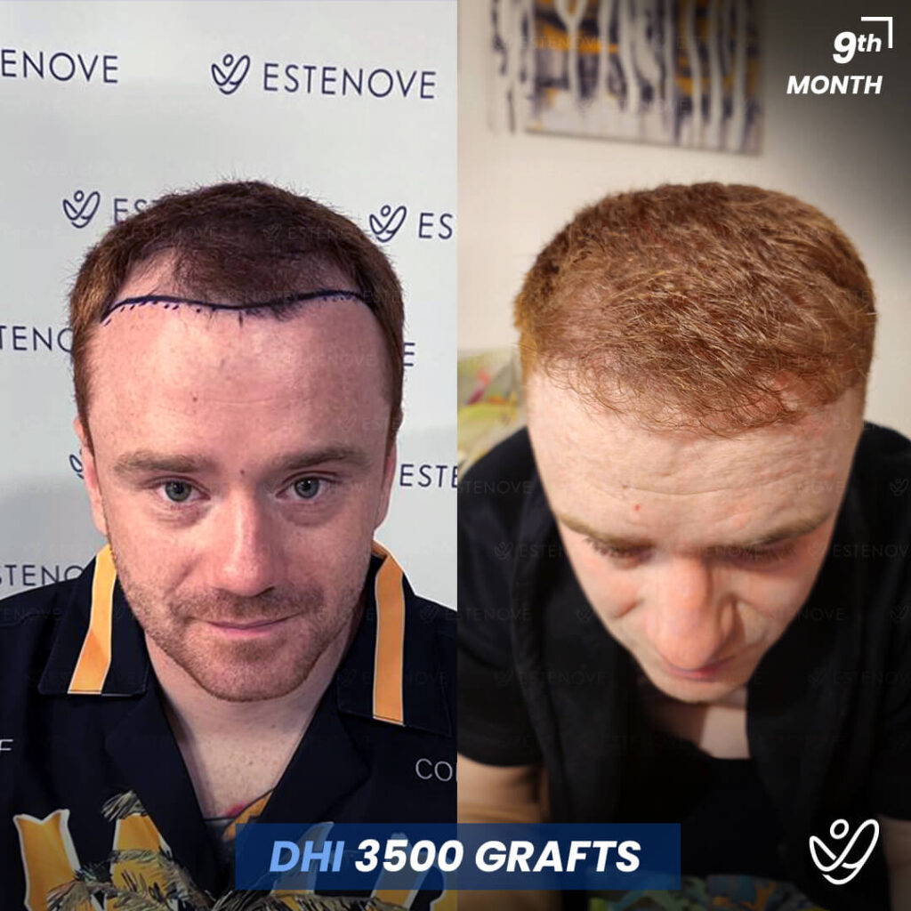 Male DHI 3500 Grafts 9 Months Before&After