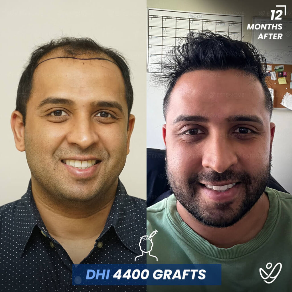 Male DHI 4400 grafts 12 Months Before&After