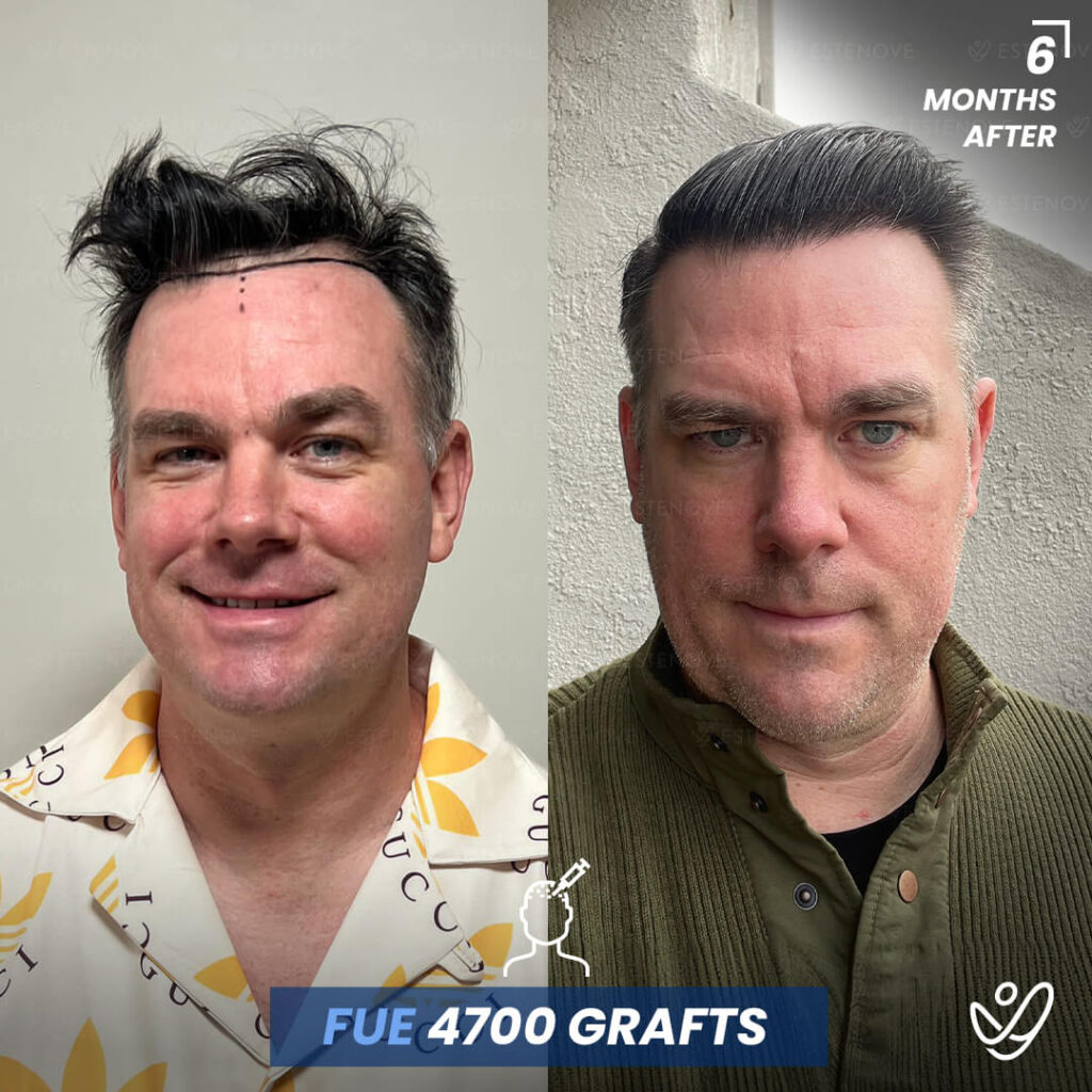 Male FUE 4700 grafts 6 Months Before&After