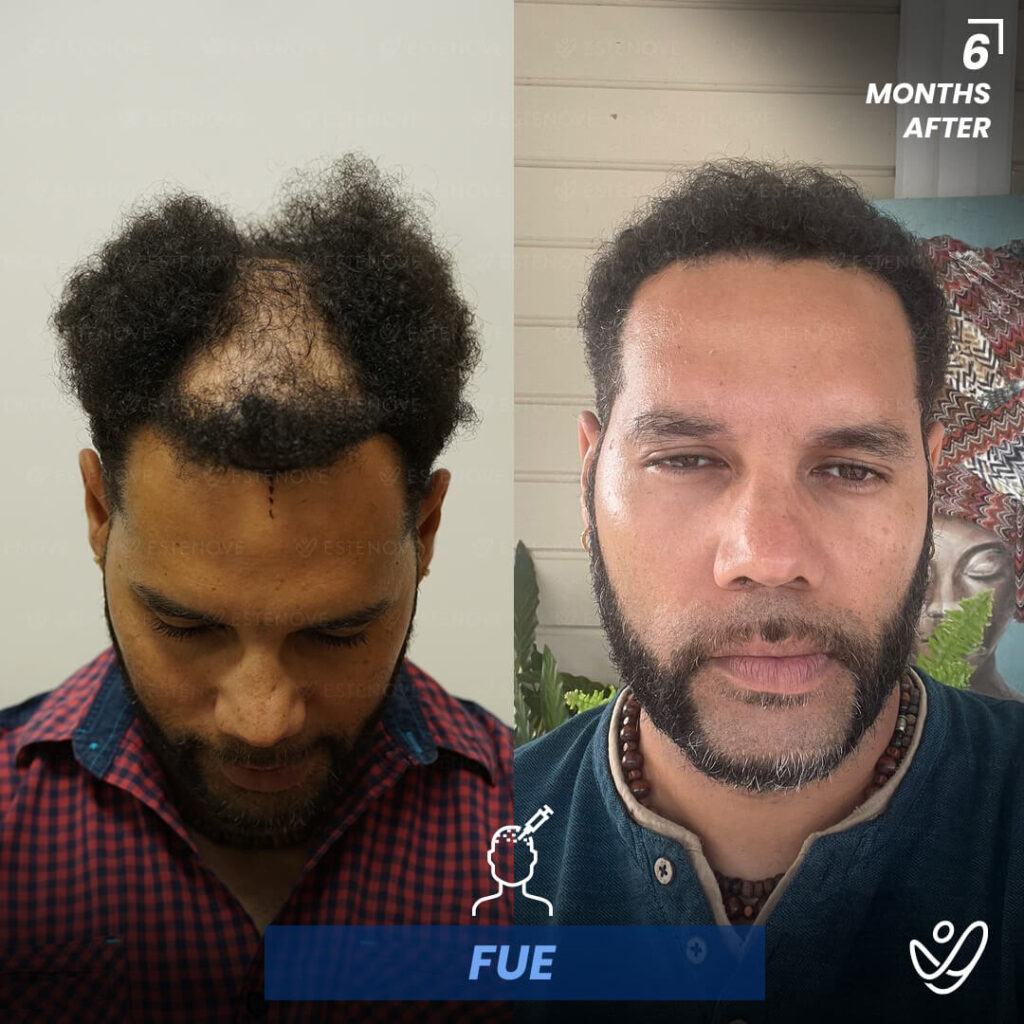 Male FUE 6 Months Before&After