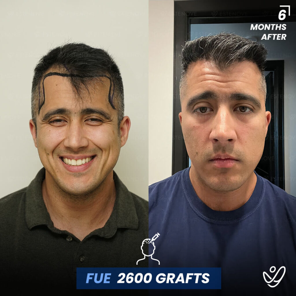 Male FUE 2600 grafts 6 Months Before&After