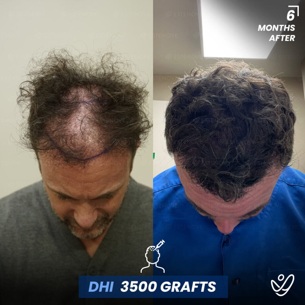 Male DHI 3500 grafts 6 Months Before&After