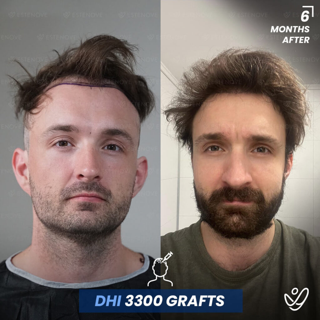 Male DHI 3300 grafts 6 Months Before&After