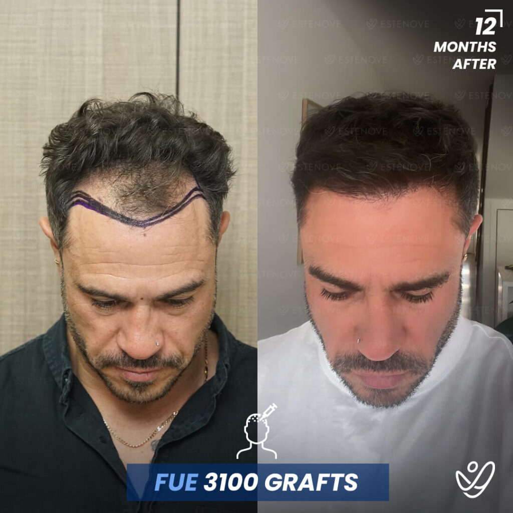 Male FUE 3100 grafts 12 Months Before&After