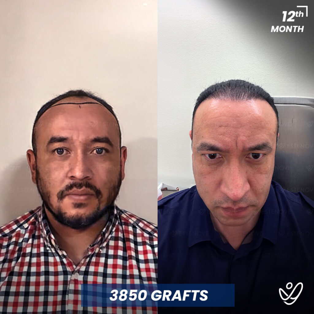 Male 3850 Grafts 12 Months Before&After