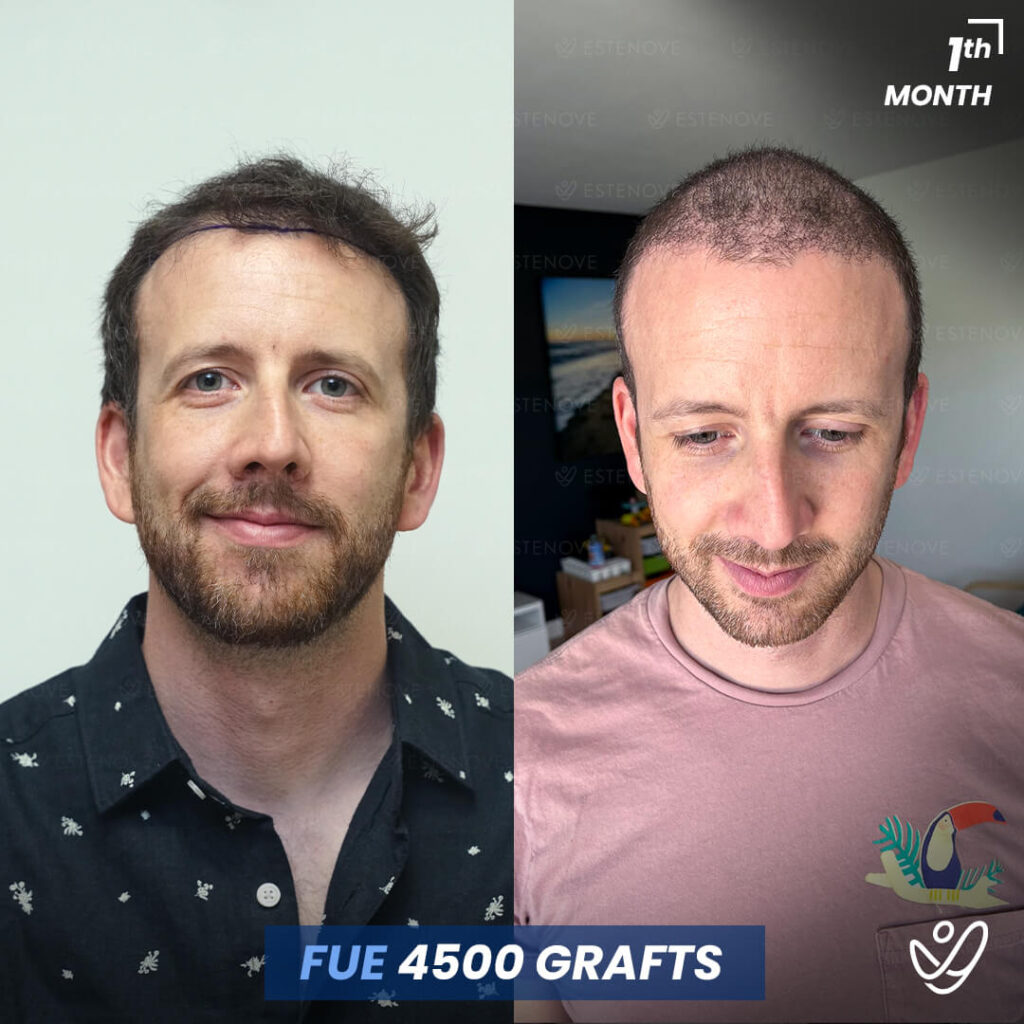 Male FUE 4500 Grafts 1 Months Before&After