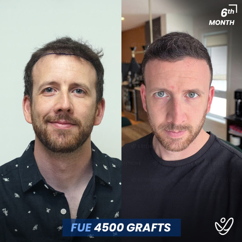 Male FUE 4500 Grafts 6 Months Before&After