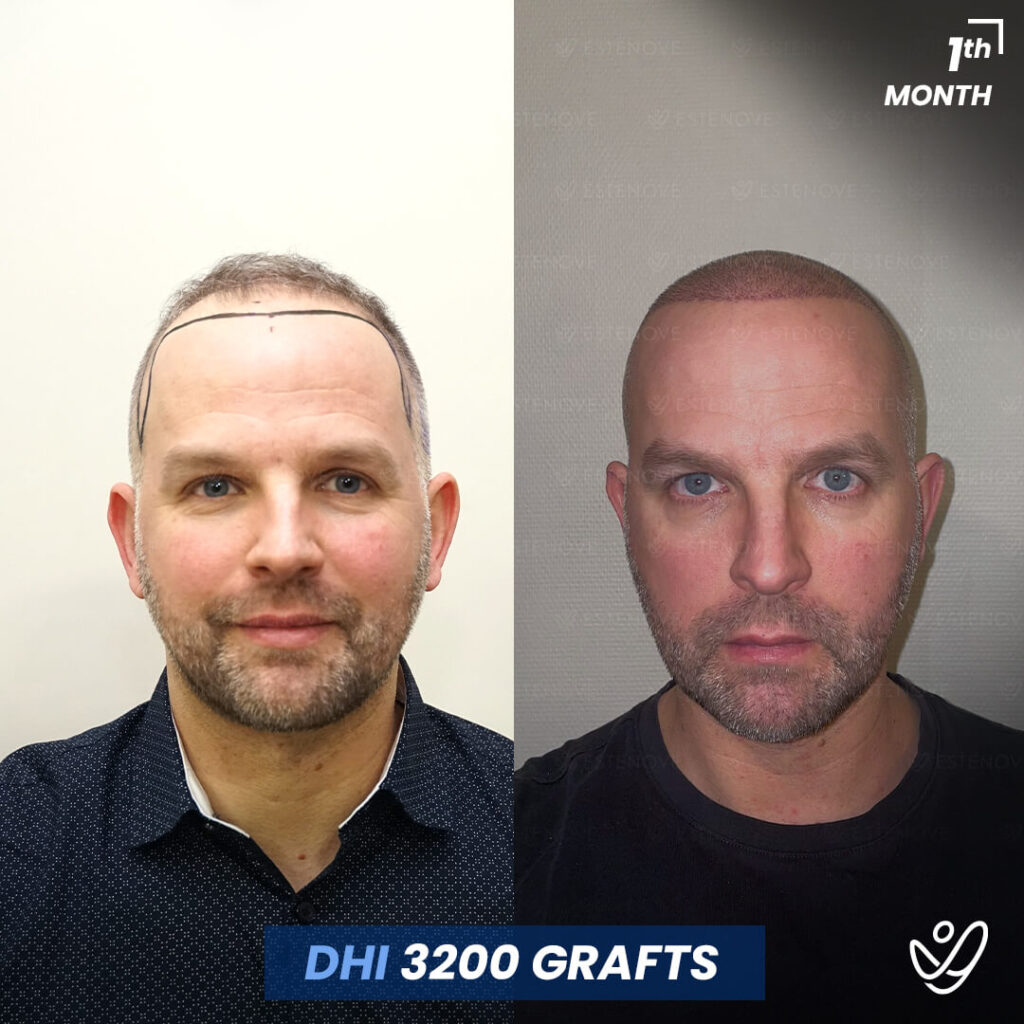 DHI Hair Transplant, 1 Month Before After, 3200 Grafts