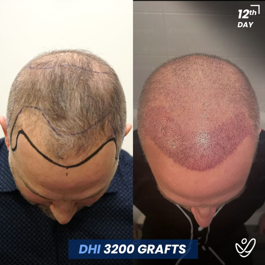 Male DHI, 3200 Grafts, 12 Days After Hair Transplant