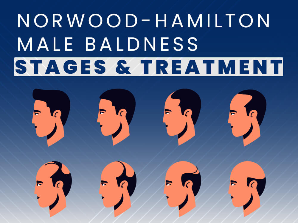 Norwood-Hamilton Scale Male Pattern Baldness Stages and Treatment