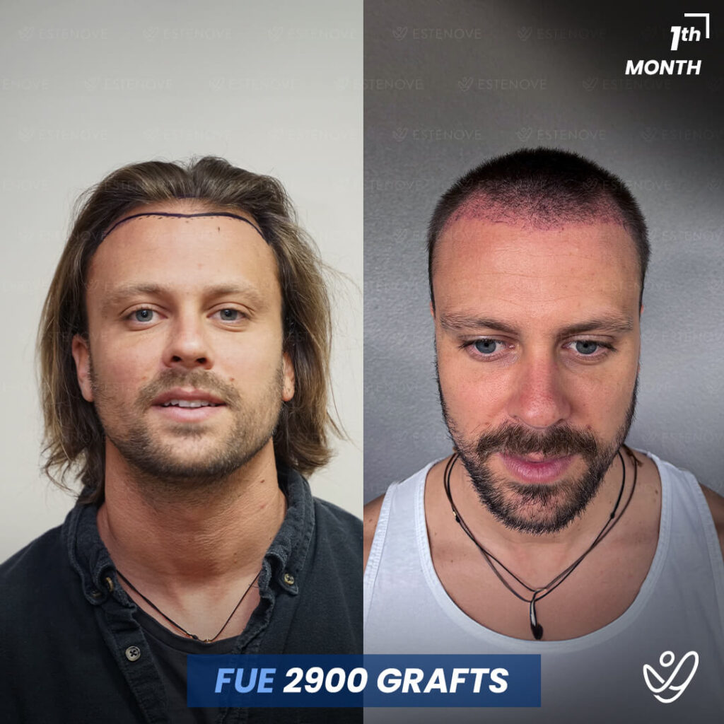 FUE Hair Transplant, 1 Month Before After, 2900 Grafts