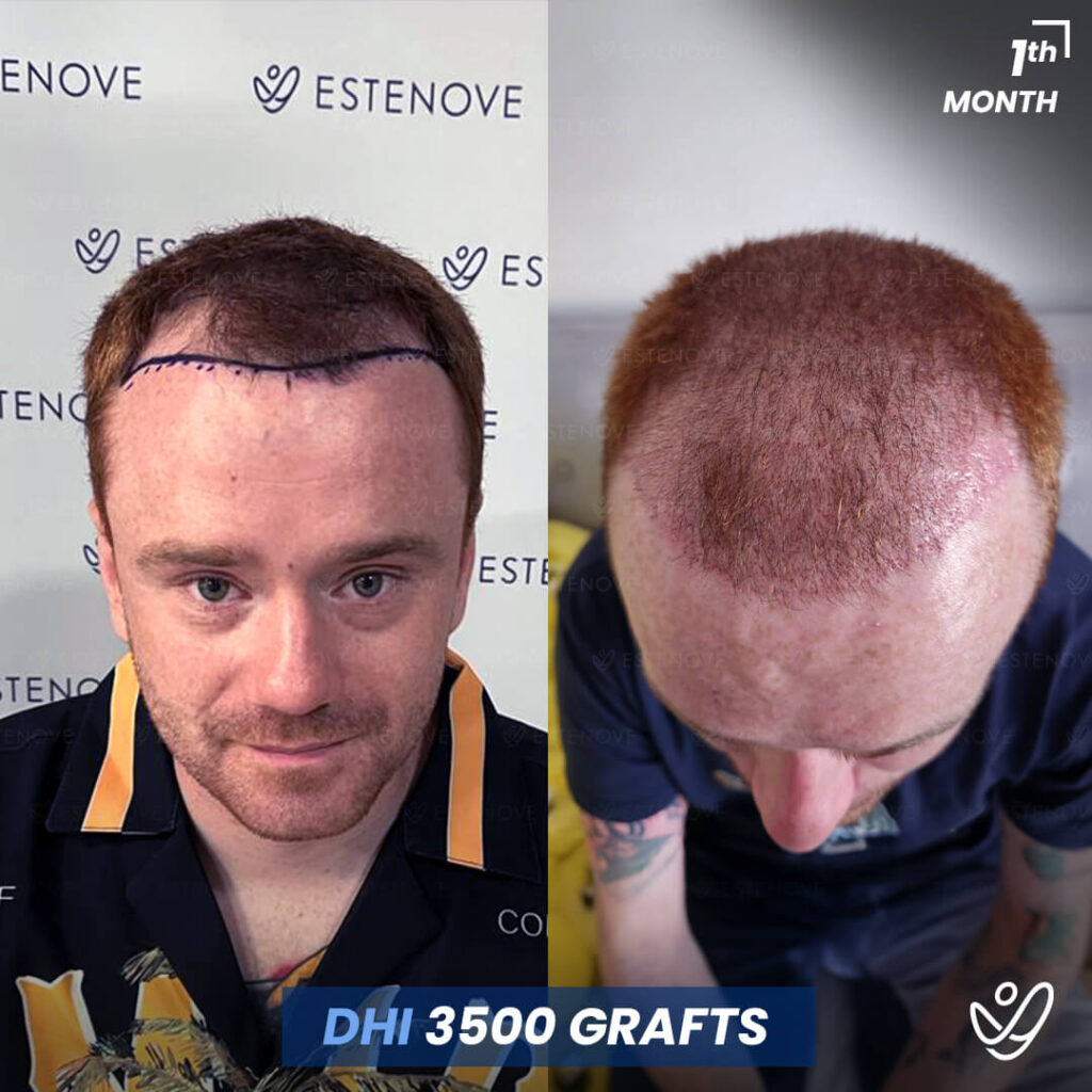 Male DHI 3500 Grafts 1 Month Before&After Hair Transplant