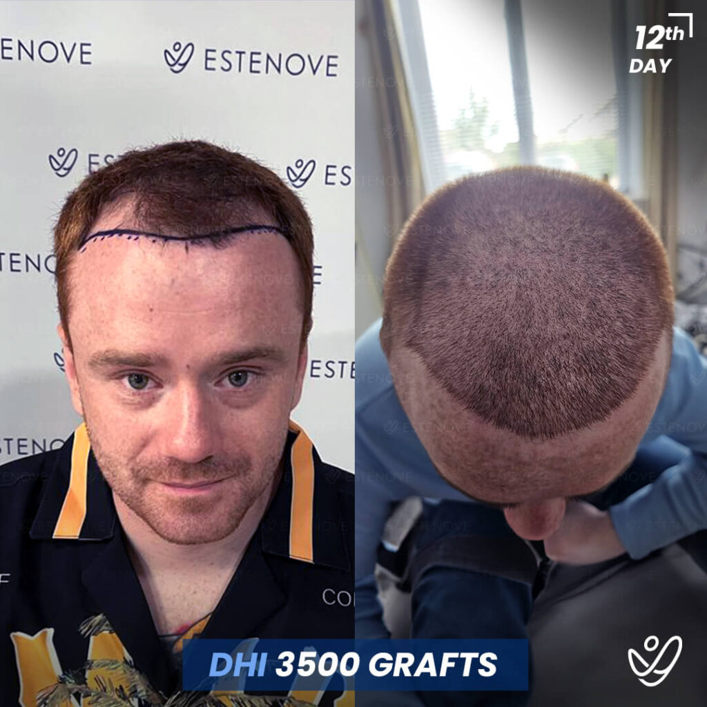 Male DHI 3500 Grafts 12 Days Before&After Hair Transplant