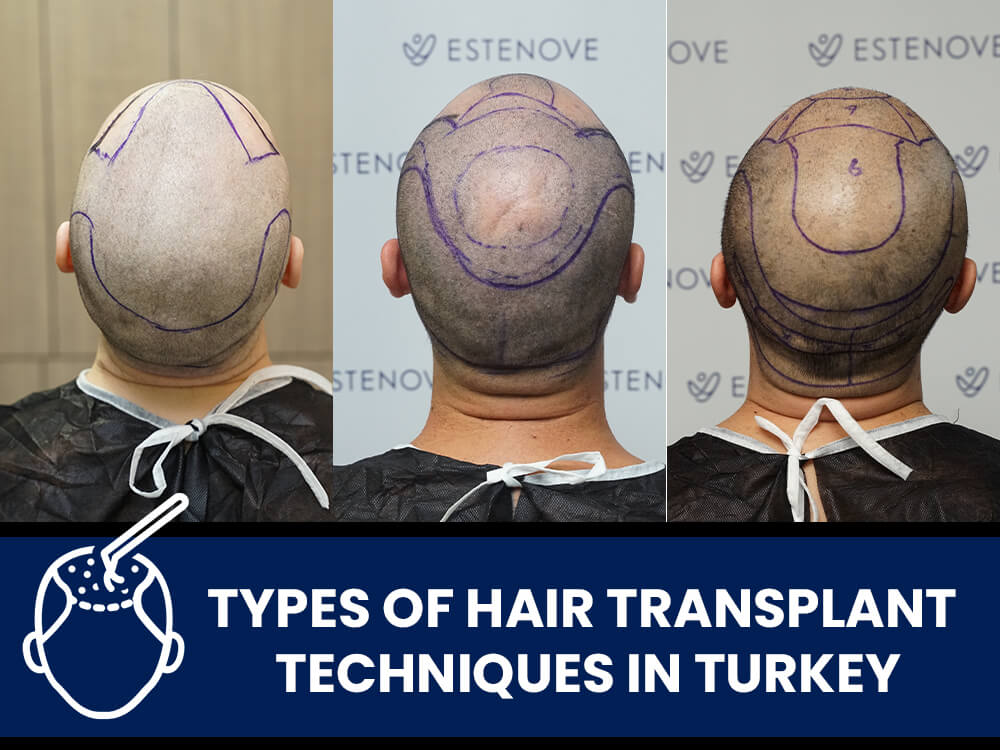 Types-of-Hair-Transplant-Techniques-in-Turkey