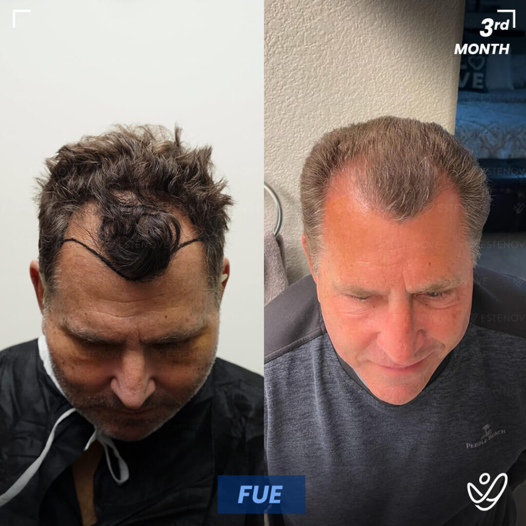 Male, FUE, 3 Months After Hair Transplant