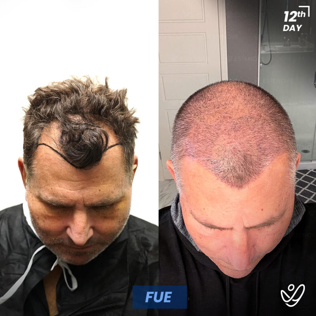 Male FUE Hair Transplant, 12 Day After