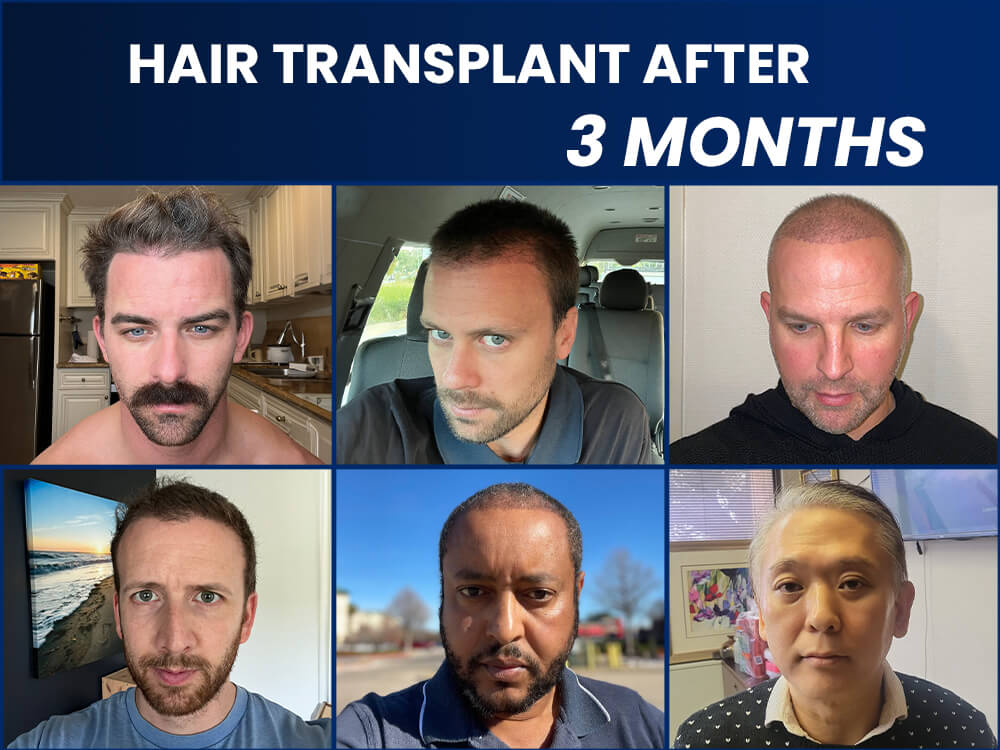 hair transplant results after 3 months