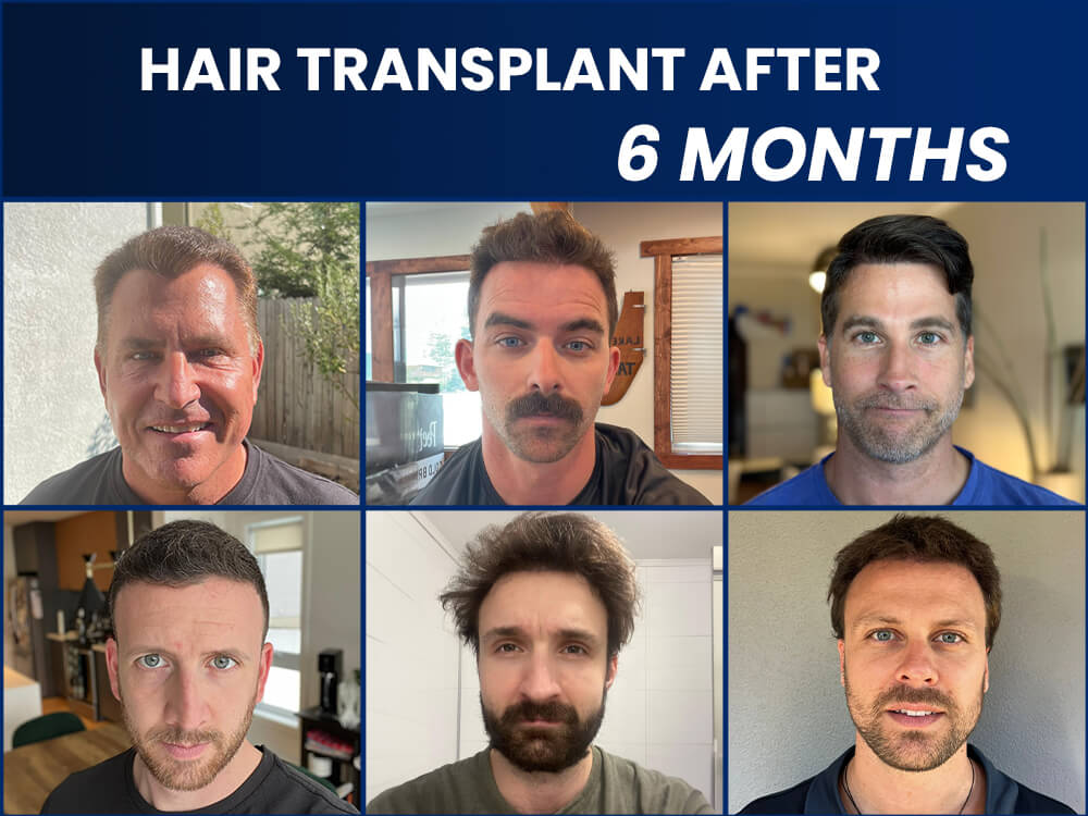 hair transplant results after 6 months