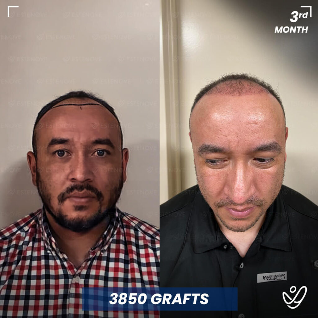 Male, 3 Months After Hair Transplant, 3850 Grafts