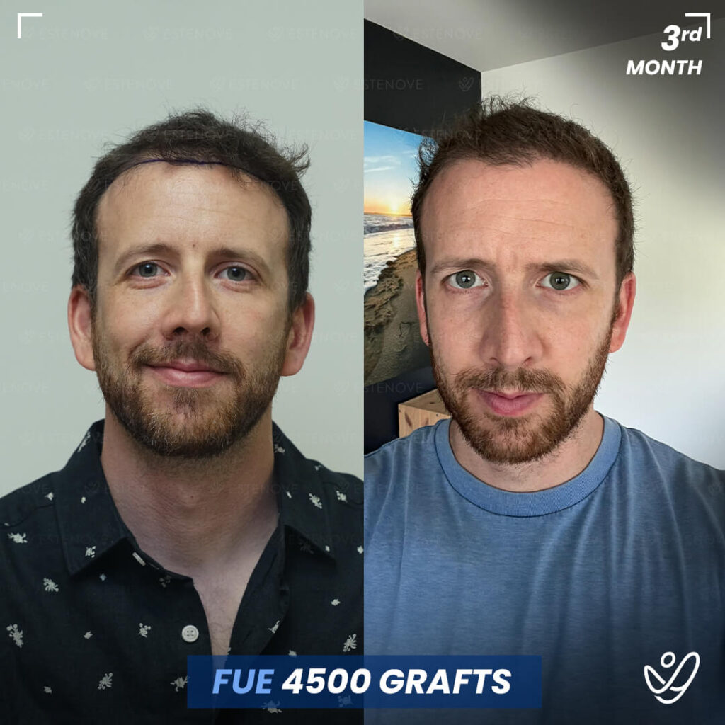 Male FUE 4500 Grafts 3 Months Before&After