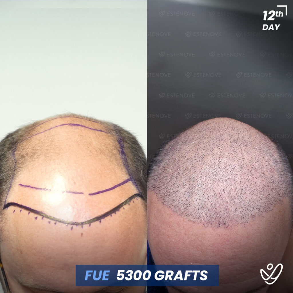 Male FUE, 5300 Grafts, 12 Days After Hair Transplant