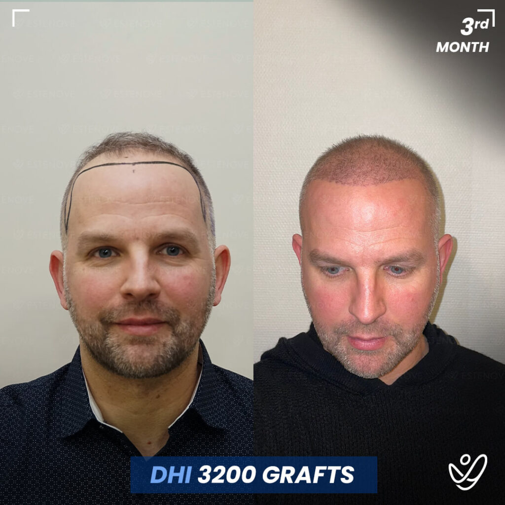 Male, DHI, 3 Months After Hair Transplant, 3200 Grafts