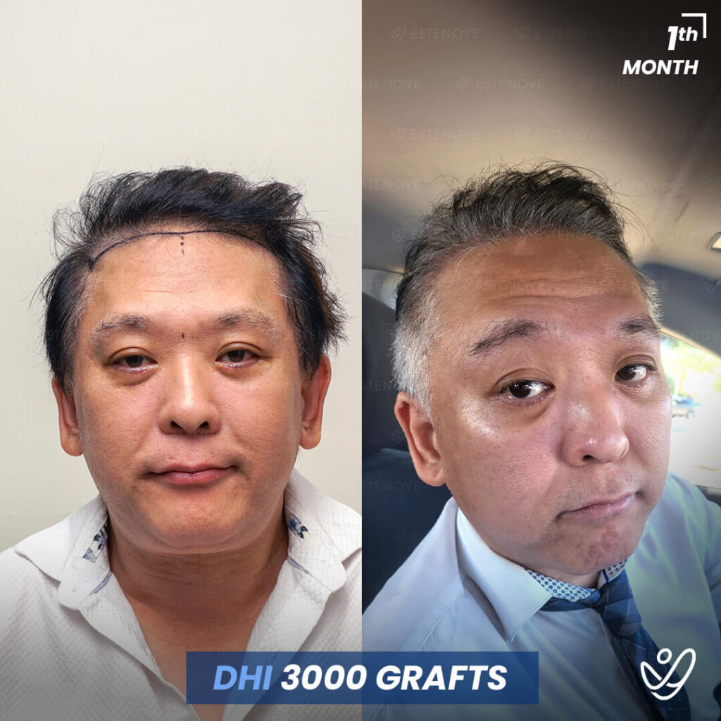 Male, DHI, 1 Month After Hair Transplant, 3000 Grafts