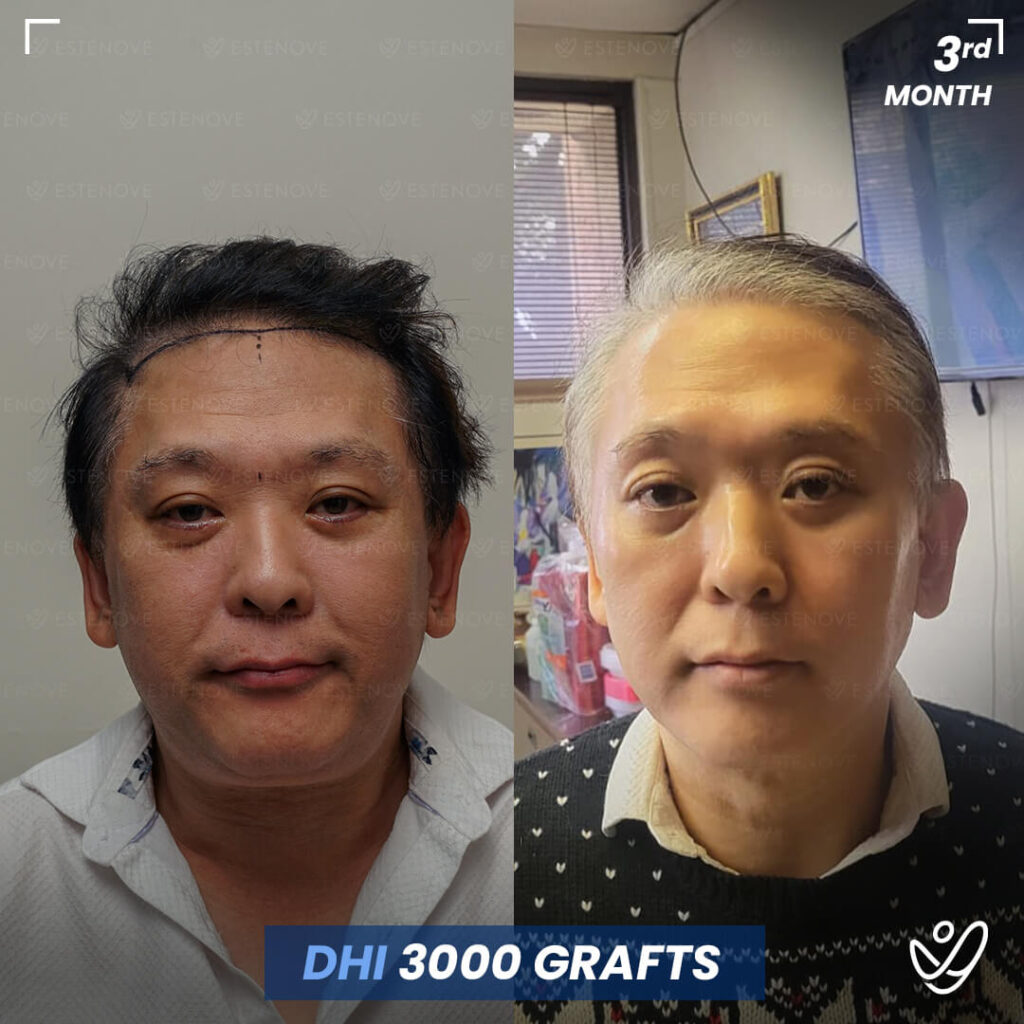 Male, DHI, 3 Months After Hair Transplant, 3000 Grafts