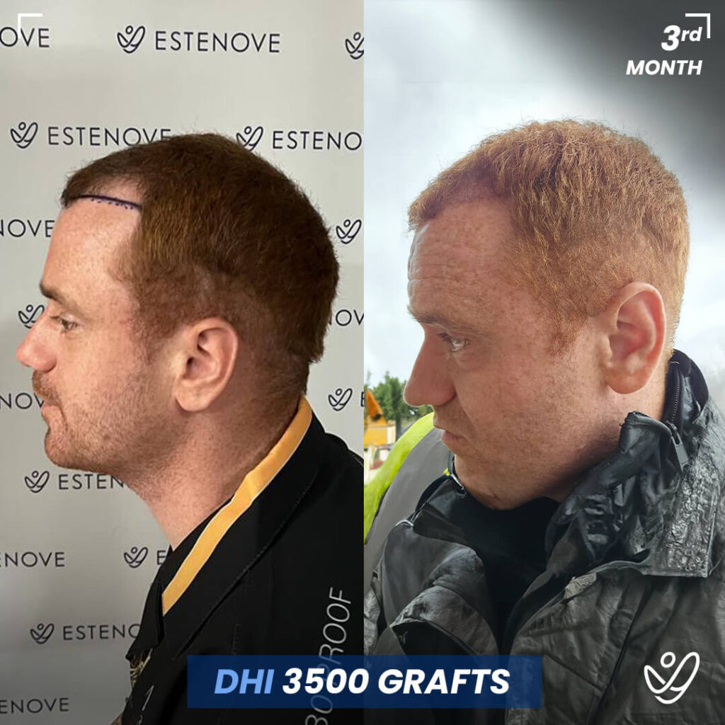 Male, DHI, 3 Months After Hair Transplant, 3500 Grafts