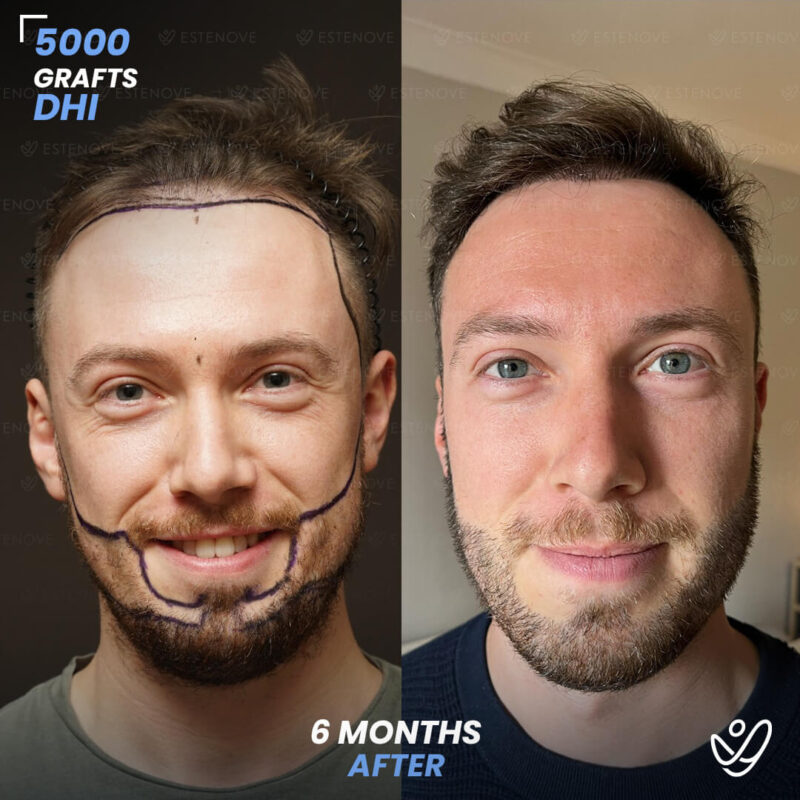 DHI 5000 Grafts Hair & Beard Transplant, 6 Months Before After, William Chisholm