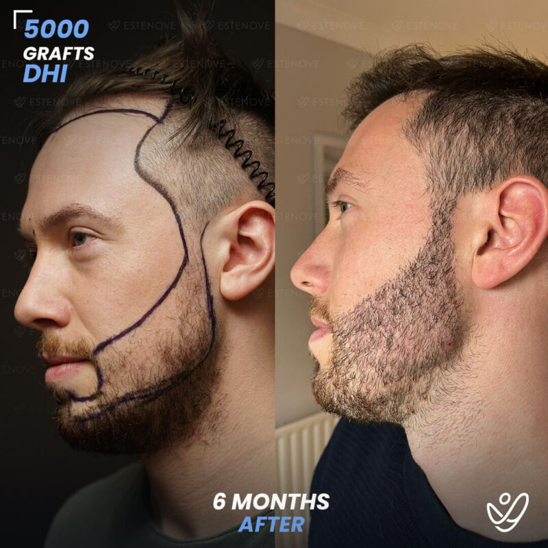 DHI 5000 Grafts Hair & Beard Transplant, 6 Months Before After, William Chisholm