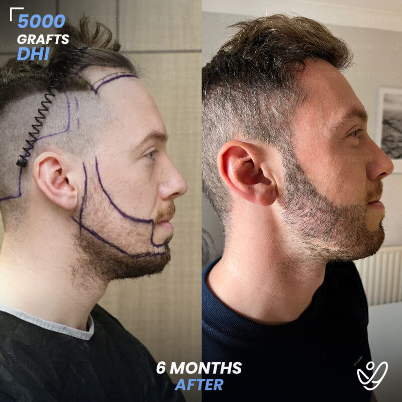 DHI 5000 Grafts Hair & Beard Transplant, 6 Months Before After, William Chisholm