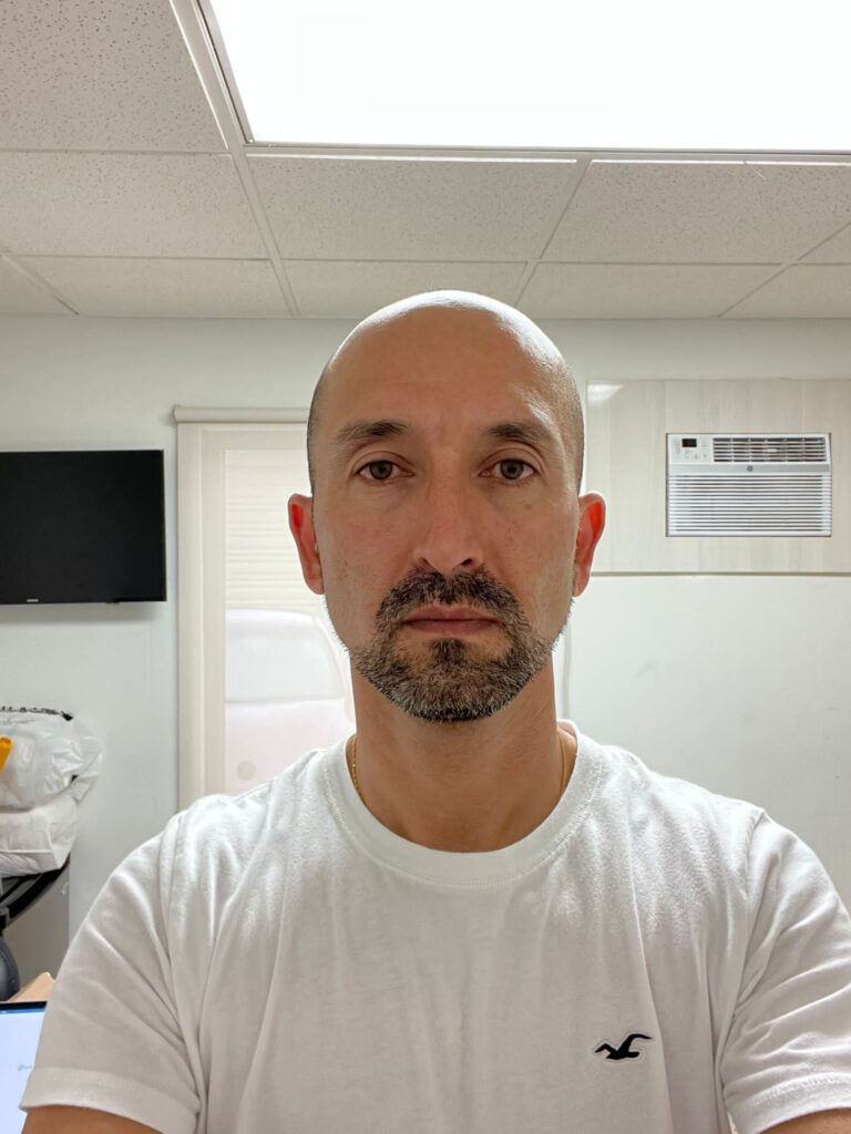 Before Hair Transplant Photo