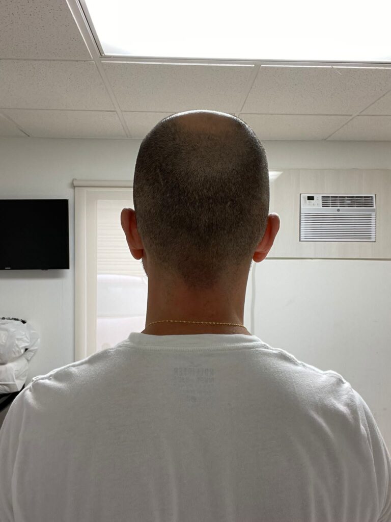 Before Hair Transplant Photo